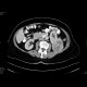 Renal cell carcinoma: CT - Computed tomography